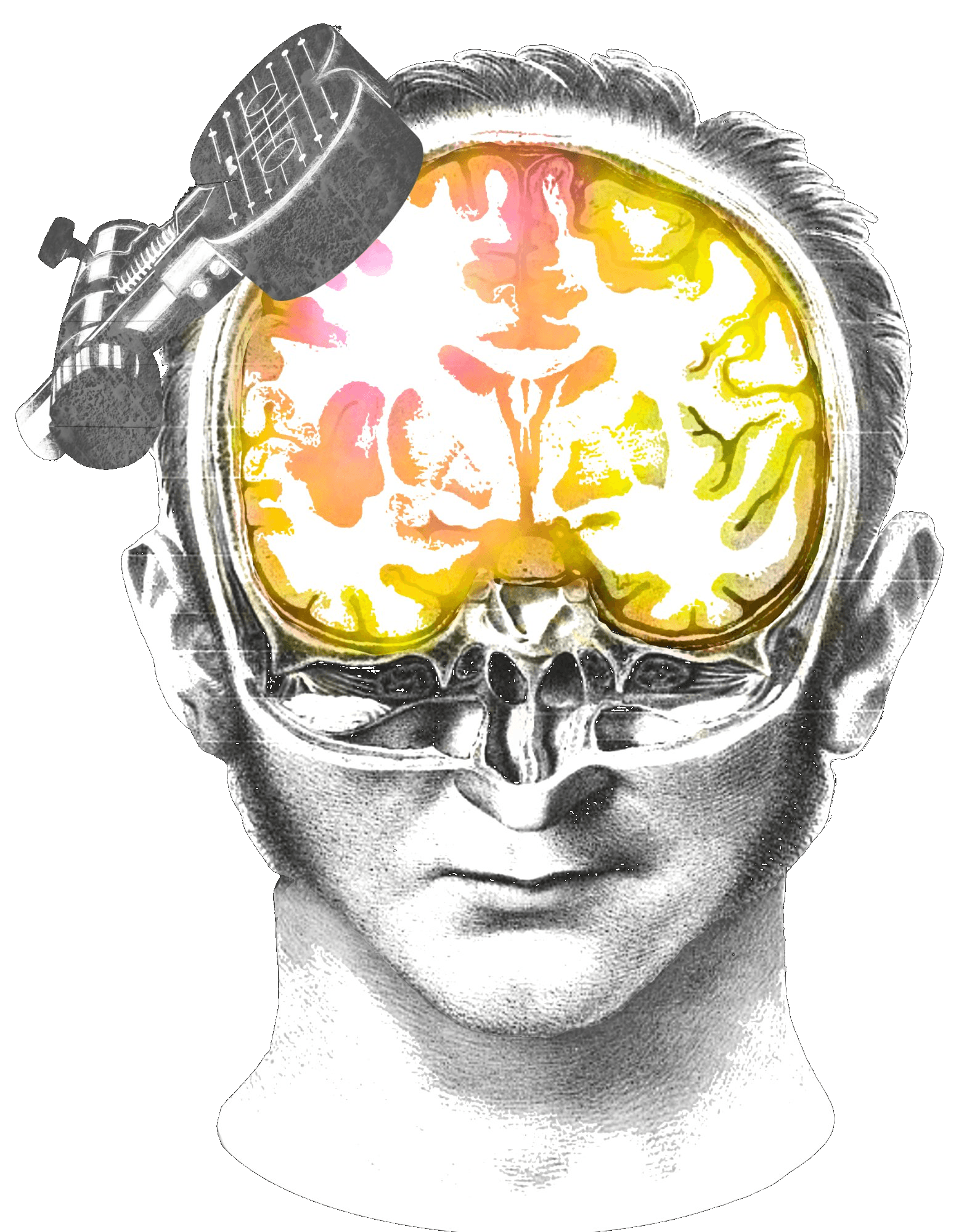 Patient receiving rTMS treatment at Bloom rTMS clinic in Calgary